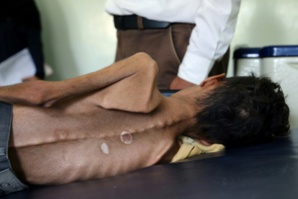 Ghazi Ali ben Ali, un Yéménite de 10 ans qui souffre de malnutrition aigüe, est allongé sur un lit le 30 octobre 2018 dans un hôpital de Jabal Habashi près de la ville de Taëz, dans le sud du Yémen (photo et légende AFP)