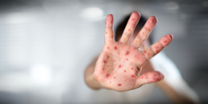 La rougeole a tué 140.000 personnes l'an dernier, déplore l'OMS