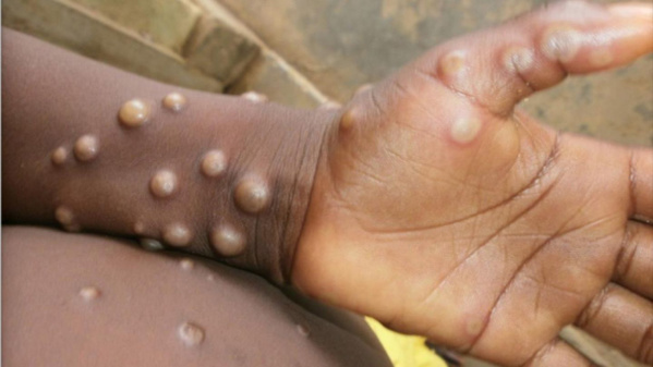 Mpox : ce qu'il faut faire pour éviter une pandémie mondiale, alors que les cas explosent en Afrique Mpox : ce qu'il faut faire pour éviter une pandémie mondiale, alors que les cas explosent en Afrique