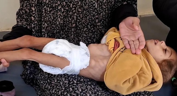 Des organisations humanitaires alertent sur la malnutrition infantile à Gaza