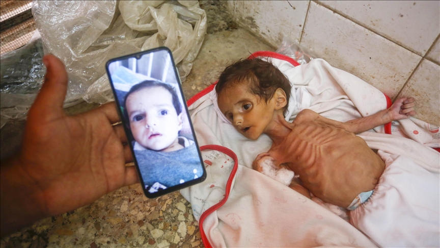 Cet enfant est une des victimes de la barbarie d'Israël contre les Palestiniens du ghetto de Gaza