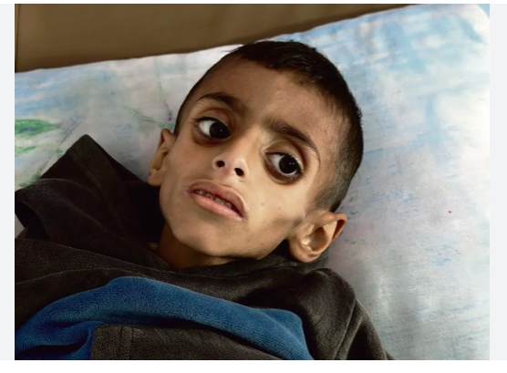 Un enfant de Gaza victime de la famine décrétée par Israël avec l'appui décisif des Etats-Unis