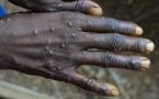 Épidémie de Mpox - L’agence de santé de l’Union africaine pourrait déclarer « une urgence de santé publique »