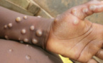 Mpox : ce qu'il faut faire pour éviter une pandémie mondiale, alors que les cas explosent en Afrique