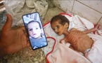 Gaza : 66 enfants morts de malnutrition aiguë depuis octobre 2023